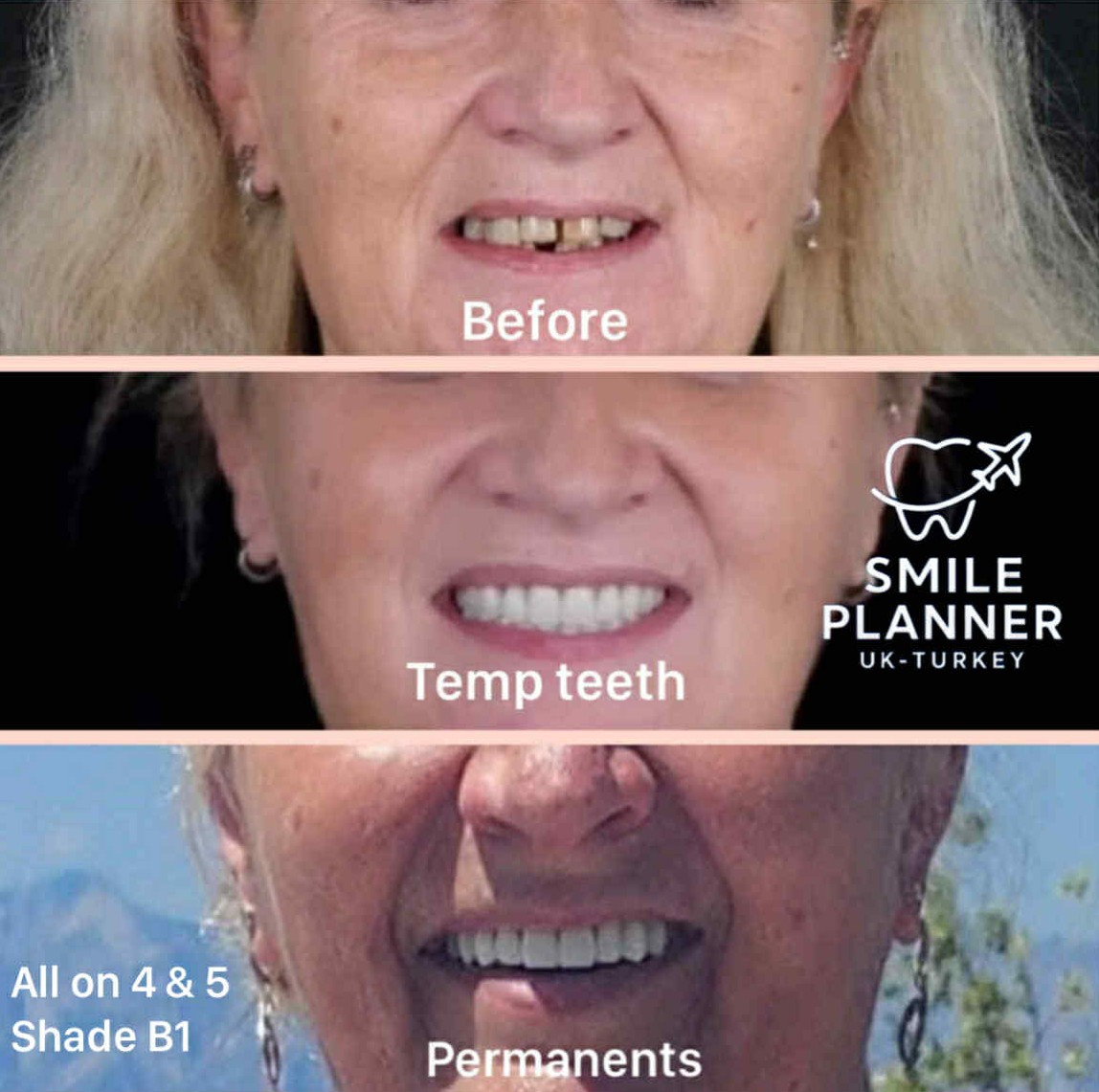 smile transformation all-on-5